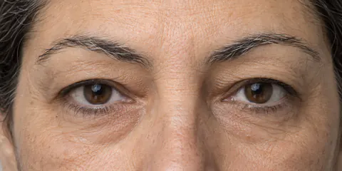 Ejemplo de ojos encapotados: un pliegue de piel que baja del hueso de la ceja cubre casi todo el pliegue del párpado.