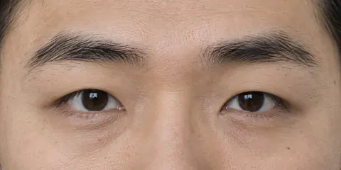Ejemplo de ojos de párpado único (monolid): un párpado superior liso, sin pliegue visible.