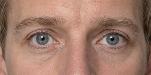 Ejemplo de ojos redondos: una abertura alta con parte del blanco visible por encima o por debajo del iris.